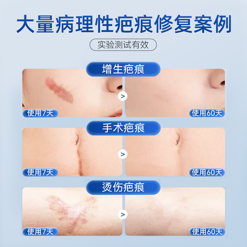 【美国进口硅酮】医用硅酮凝胶祛疤膏去疤痕修复除疤除疤膏第一名