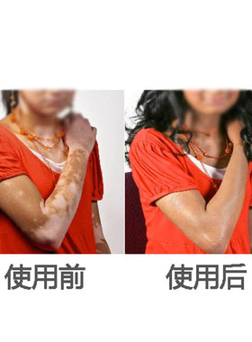 原装俄罗斯菌膏白店风膏白色斑点软膏皮肤护理按摩膏柏电枫15g/盒