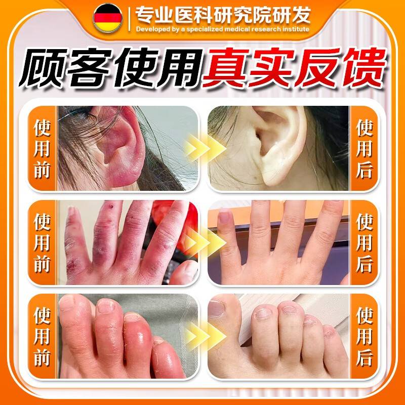 冻疮特效膏药护手霜冻疮膏止痒冻伤膏药膏排行榜名耳朵修复膏 - 图1