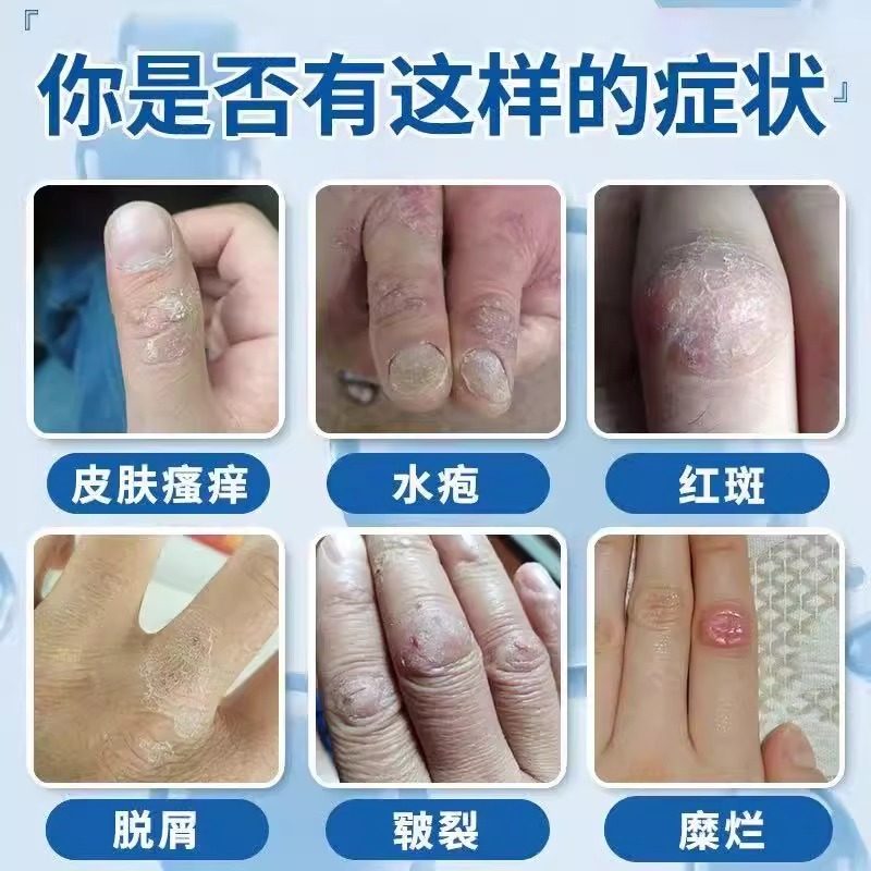 手指关节癣手癣脱皮干裂真菌感染湿疹手足硬皮止痒药监备案药膏LL,淘宝优惠券,粉丝福利购,淘宝优惠卷