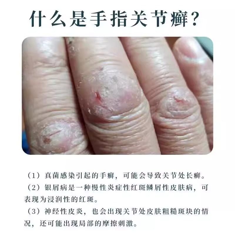 手指关节癣手癣脱皮干裂真菌感染湿疹手足硬皮止痒药监备案药膏LL,淘宝优惠券,粉丝福利购,淘宝优惠卷