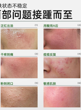 弥芙泉油橄榄祛痘退红精华液