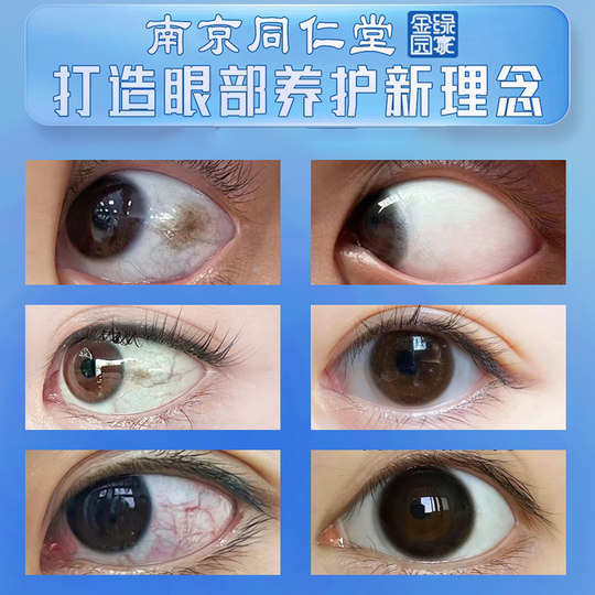 Макулярная болезнь, слезотечение, пожелтение белков глаз, ясные глаза, желтые глаза, мутное глазное дно, глазные капли с лютеином и черникой, настоящие