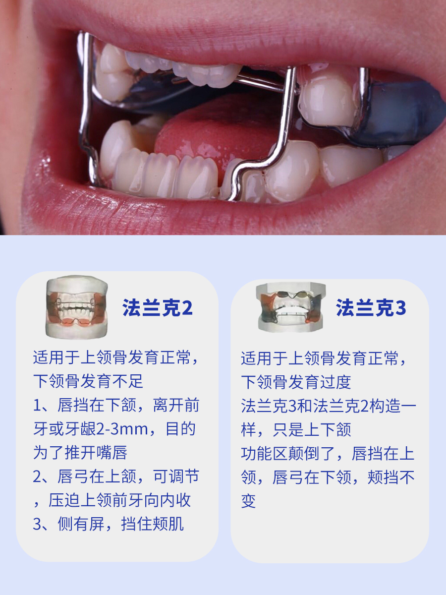 法兰克3儿童牙齿隐形矫正器地包天龅牙牵引扩弓器深覆合反颌正畸 - 图2