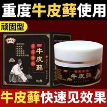 Miao Ago Psoriasis Special Ointment Centuries-old Pass of Miao silver chip paste Benherbal skin External pasta for care and coagulation
