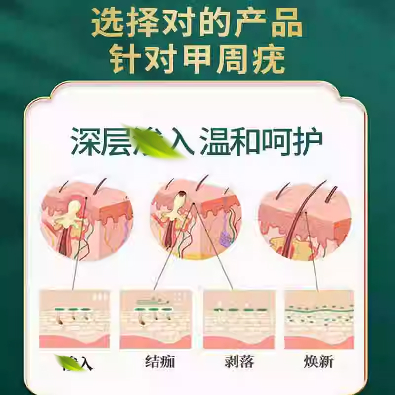 甲周疣专攻甲下疣甲旁疣寻常疣手部指甲点疣膏专用祛疣kj-图1