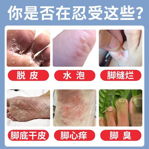 治脚气专用药水泡脱皮止痒烂脚丫痒脚趾缝糜烂型治疗真菌感染 - 图3