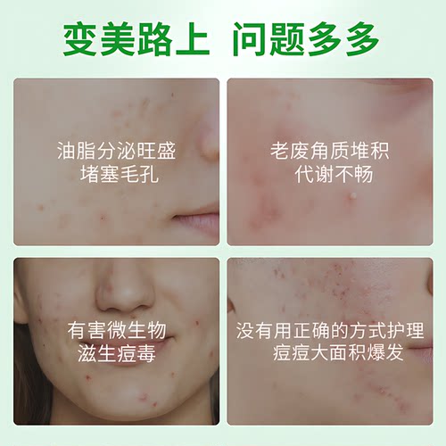 芦荟凝胶官方正品补水保湿晒后祛痘印专用坑膏旗舰女男士淡化修复 - 图1