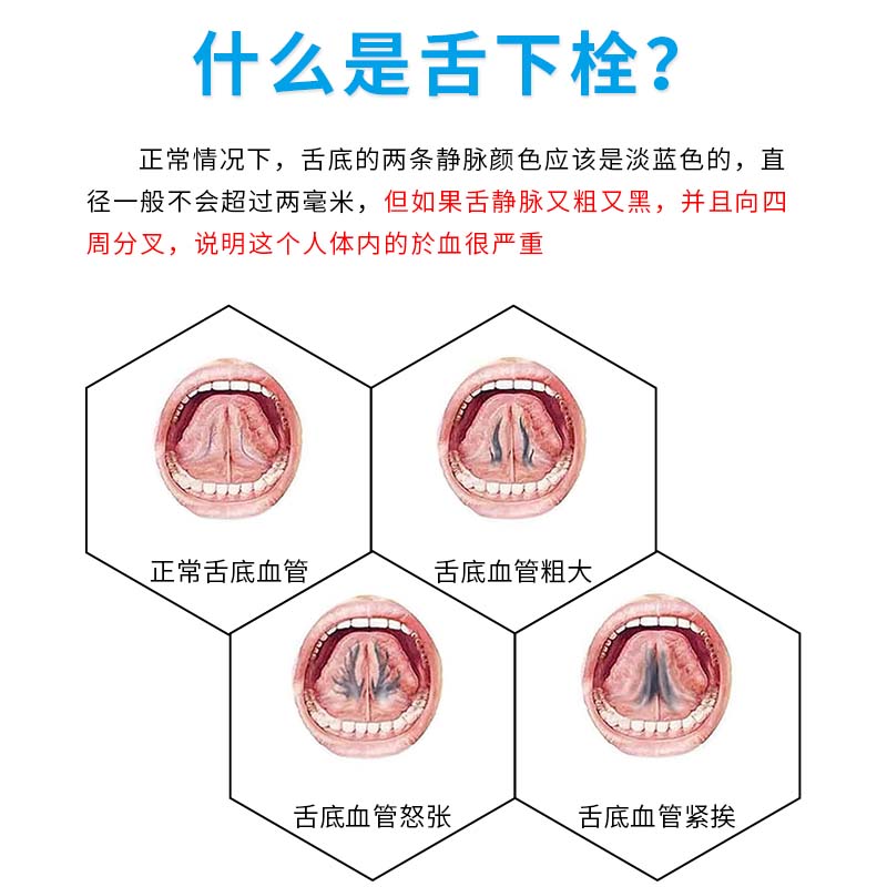 舌下青筋又黑又粗淤血疏通一喷灵舌头底血管怒张舌下淤堵舌底溶栓 - 图1