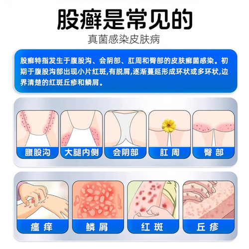 盐酸特比萘芬蔡芬正品凝胶股藓廯癣专用药大腿内侧皮肤瘙痒 - 图0