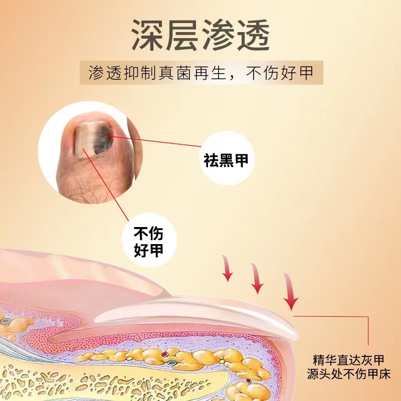 南京同仁堂绿金家园灰指甲液软甲膏剂亮甲灰指甲足部护理液