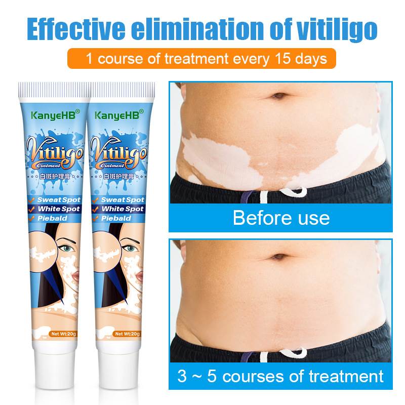 推荐20g Herbal Extract Vitiligo Ointment Remove Ringworm Whi - 图3