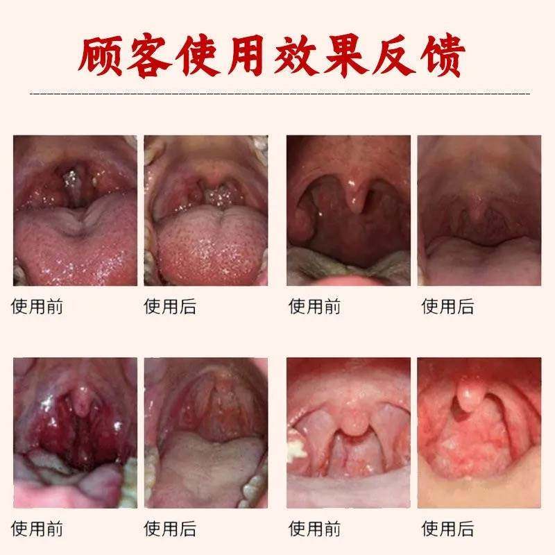 极速慢性除根贴除根C专用贴咽喉肿痛异物感,淘宝优惠券,粉丝福利购,淘宝优惠卷
