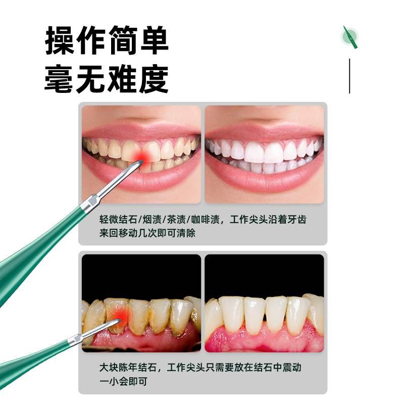 超声波电动冲牙器去除牙结石牙污垢清洁美白牙齿家用牙周炎清洗器-图3