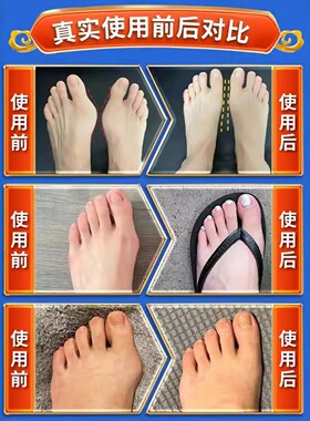 【已冶愈10万人】拇外翻贴脚趾重叠防磨大脚骨外翻矫正专用膏药