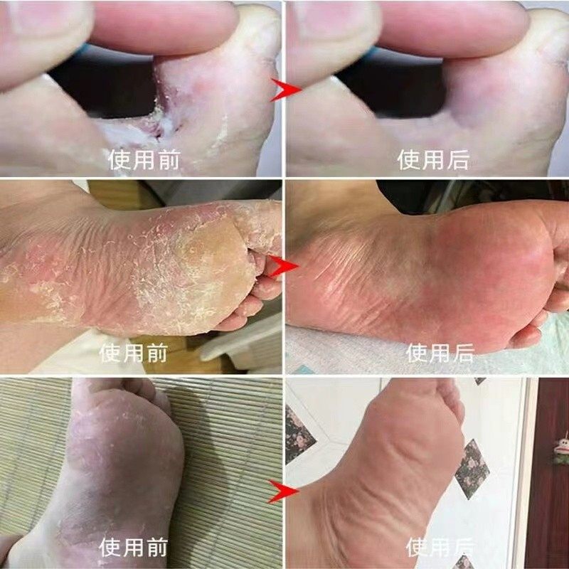 鹤叔推荐甲硝唑粉止痒脱皮烂脚丫真菌感染杀菌脚糜烂,淘宝优惠券,粉丝福利购,淘宝优惠卷