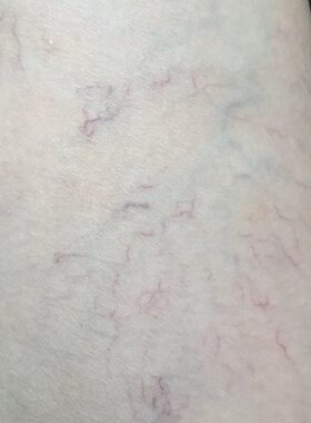 腿上有红血丝外用修复手背小腿四肢青筋凸起血丝腿软膏