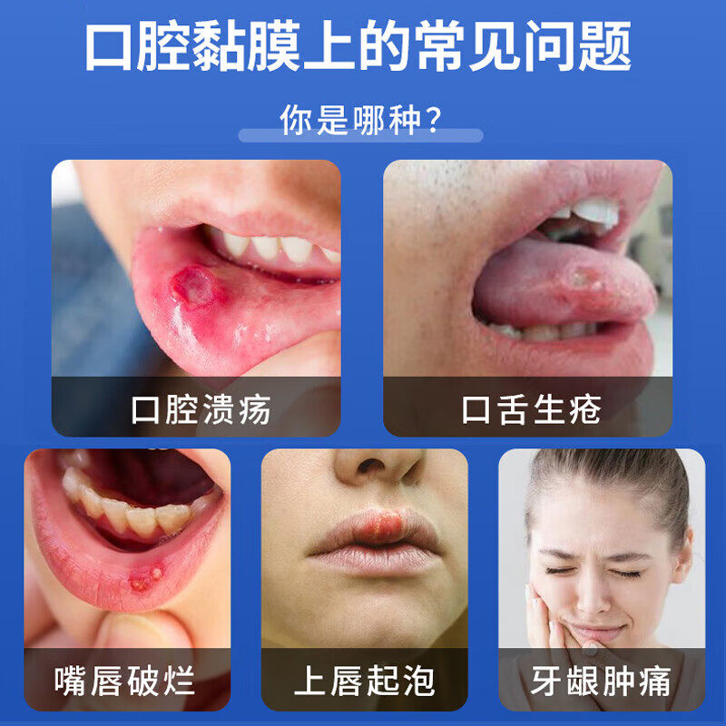 口腔溃疡专用药贴烂嘴巴烂舌头口舌生疮起泡灼痛反复口疮溃疡肿痛