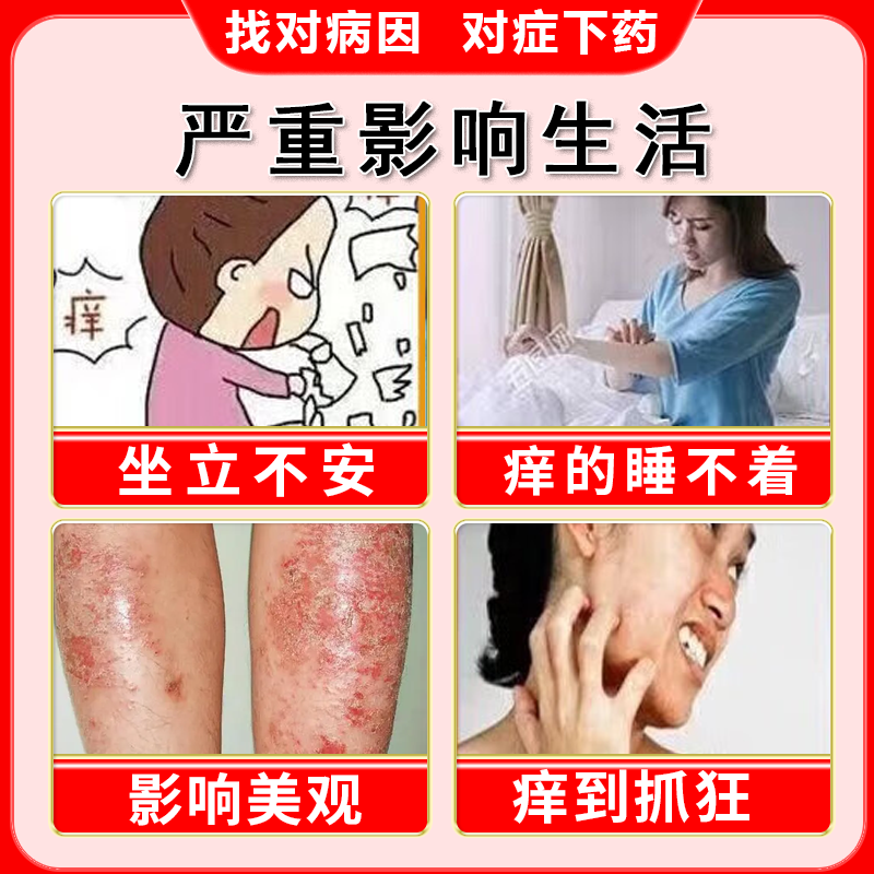 湿疹止痒去外用皮炎平999糠酸莫米松凝胶软膏根正品官方旗舰店,淘宝优惠券,粉丝福利购,淘宝优惠卷