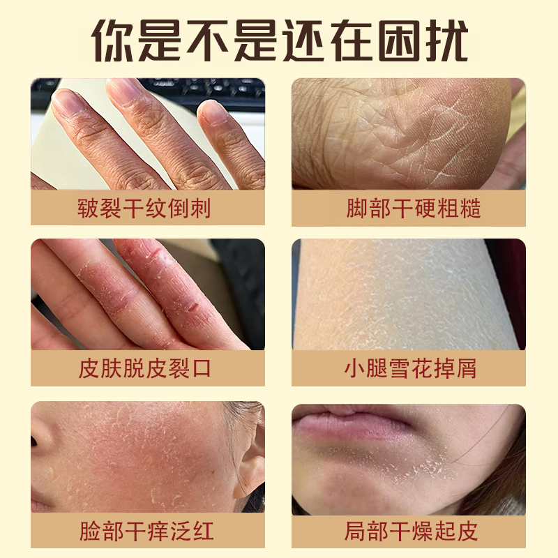 吉春参皇软膏皮肤干燥手足皲裂治手裂脚裂脚后跟干裂蛇皮肤鱼鳞病