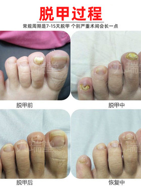 脱甲精油坏甲专用脱甲液甲清去除软甲膏增厚角质后期冰醋酸