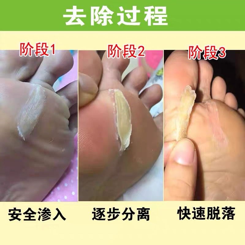 清茧宝去脚茧手茧脚底小脚趾关节茧硬G死皮老茧软化剂脚垫专用神 - 图0