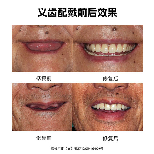 吸附义齿功能性老人活动半口假牙定制全口活动牙当天戴牙全国定制 - 图3