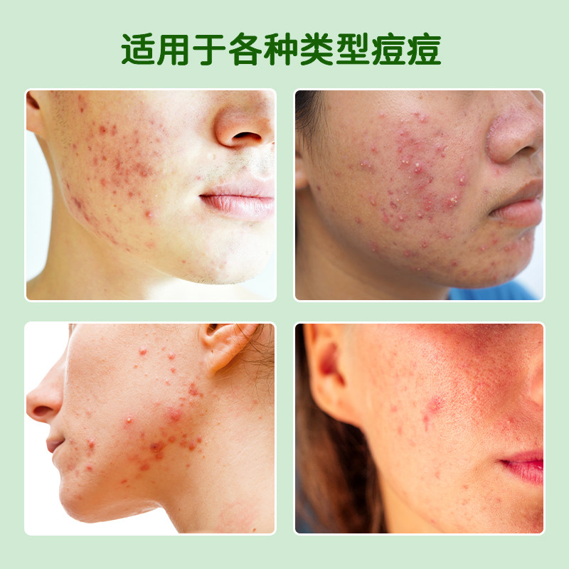 AUSLKA 9贴微针痘痘贴半透明轻薄紧急护理吸脓祛痘红肿囊痘,淘宝优惠券,粉丝福利购,淘宝优惠卷