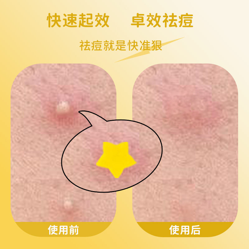 AUSLKA 黄色星星痘贴轻薄透气遮瑕水胶体亲肤植物精油温和祛痘贴,淘宝优惠券,粉丝福利购,淘宝优惠卷