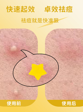 AUSLKA星星痘痘贴送镜子