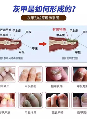 灰指甲专用电动打磨机｜老人硬厚