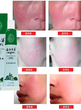 脸红发烫发热一热脸红脸部泛红刺痛脸发红发烫红脸蛋发热敏感肌