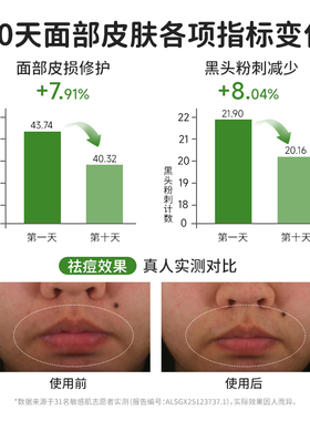 妈妈说青少年植萃祛痘水乳套装