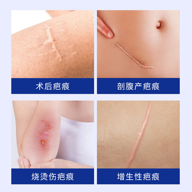 武夫人祛疤膏去疤痕贴手术疤儿童烫伤医美剖腹产修复专用医用硅酮