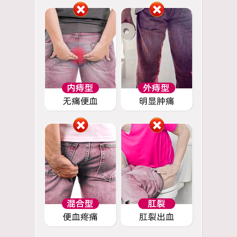 九芝堂医用卡波姆痔疮敷料内外痔混合痔肛门坠痛粘膜充血凝胶软膏,淘宝优惠券,粉丝福利购,淘宝优惠卷