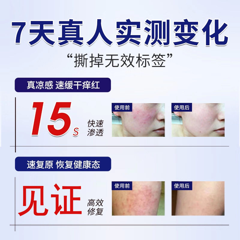 守诚堂医用皮肤护理软膏湿疹膏顽固皮炎湿疹止痒膏水泡湿疹瘙痒,淘宝优惠券,粉丝福利购,淘宝优惠卷