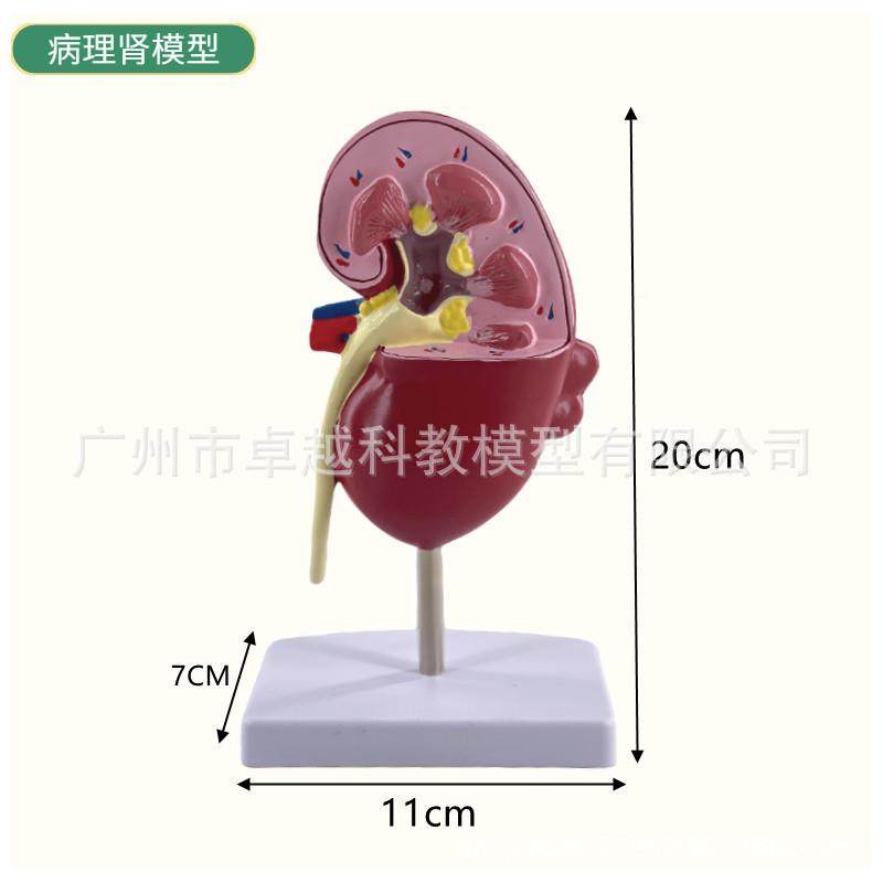 人体肾肾脏型肾解剖肾上腺放大模型877病变脏人体内脏器官解模附,淘宝优惠券,粉丝福利购,淘宝优惠卷