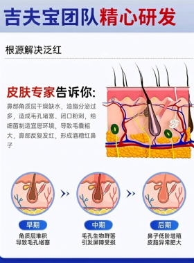 酒糟鼻草莓鼻红鼻子红肿鼻翼红血丝满力净特效专用满力净满康宁喜