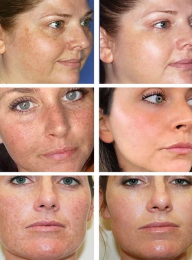 Whitening Freckle Cream Remove Melasma Cream Remove Dark Spo