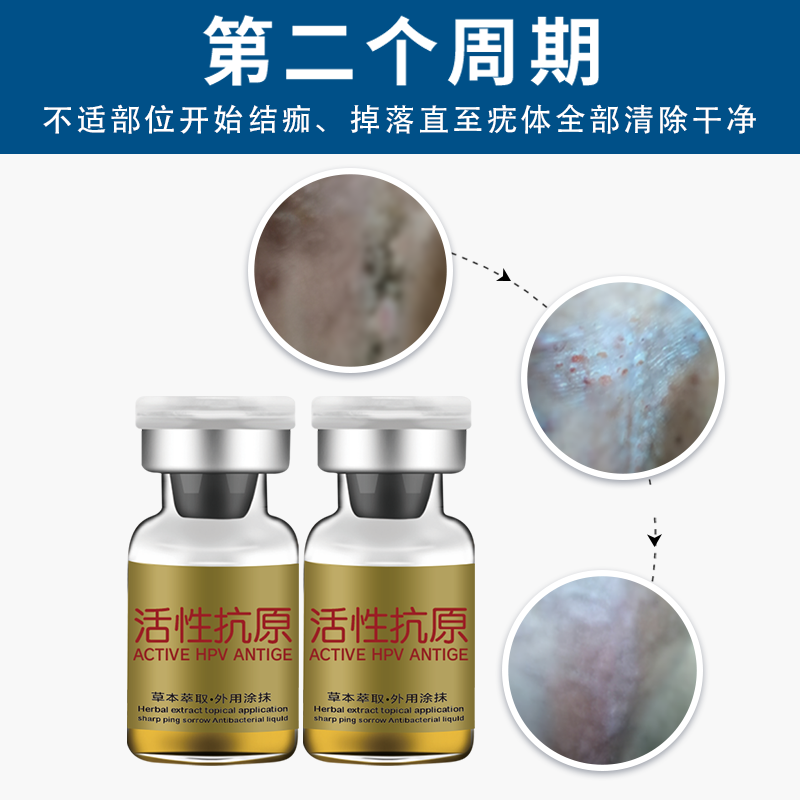 尖锐湿疣宫颈炎hpv感染扁平疣凝胶 元荣私处护理（器械）