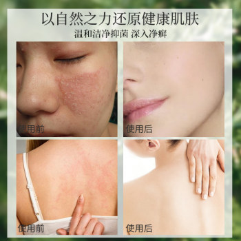 Psoriasis ຕ້ານ psoriasis urticaria eczema dermatitis ພາຍນອກຢາ ສະບູຊູນຟູຣິກ ສະບູແຊມພູອາບນ້ໍາຢາຂ້າເຊື້ອໂລກອາການຄັນ soap