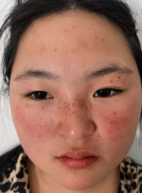 美容院雀斑点斑水老年斑提提取液