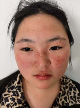 美容院雀斑生物酶提取液提取笔