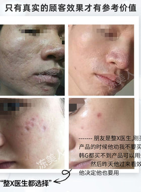 15年专注去痘坑凹洞送微针效果好