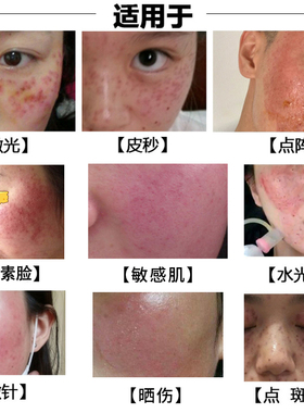 创面美容院专用激素脸修护精华液