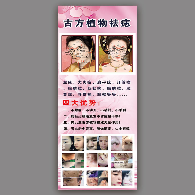 点痣图展架广告画古方祛疣宣传图面部面相挂图男女面痣图去痣脸部