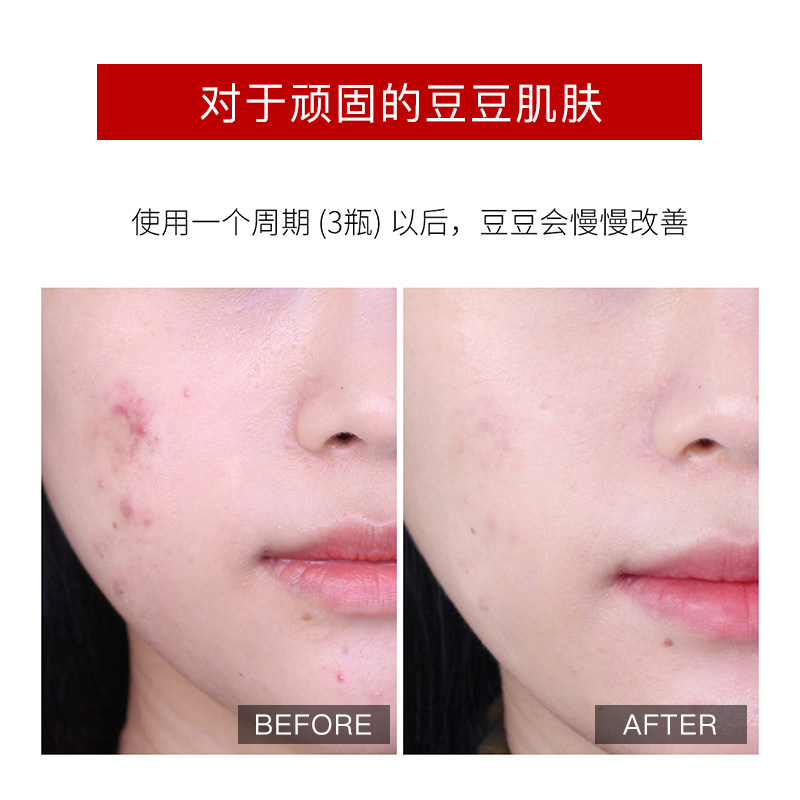 稀拉克儿痘痘精华液去闭口粉刺祛痘水杨酸淡化修护痘印痘坑小粉瓶,淘宝优惠券,粉丝福利购,淘宝优惠卷