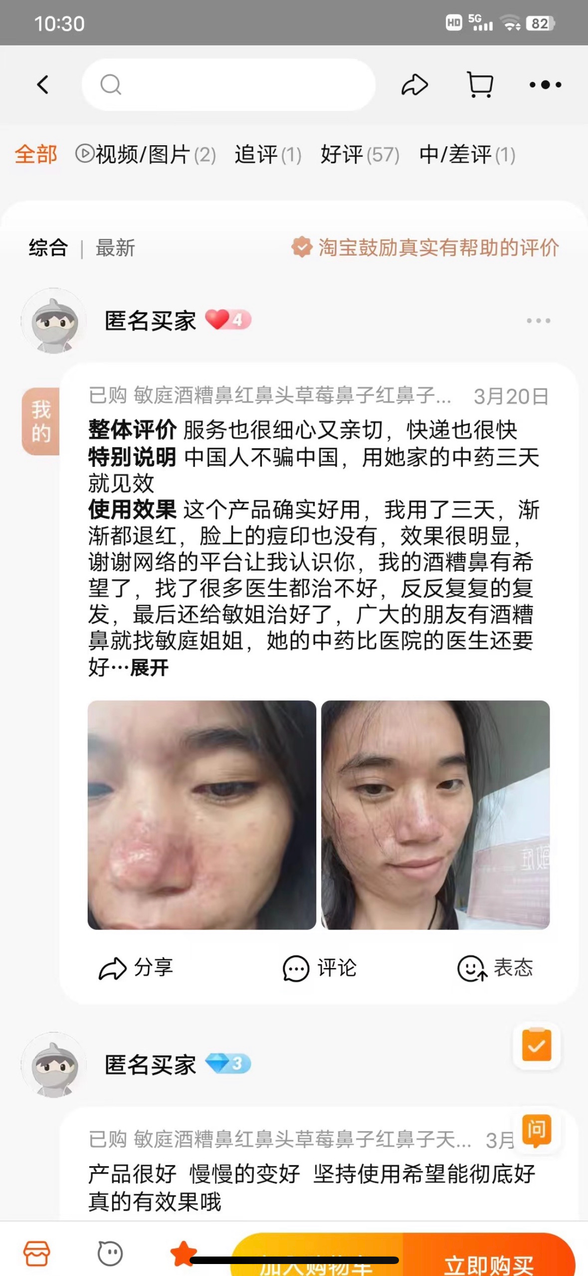 敏庭酒糟鼻草莓鼻子修复酒糟鼻专用药鼻子红血丝修复鼻子两边泛红 - 图1