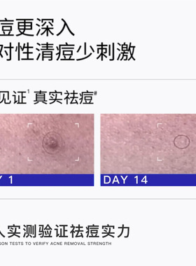 沿美博士毛囊净祛痘精华液 改善痘痘淡化痘印痘肌控油专研精华水