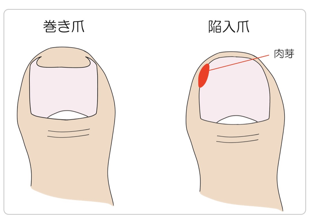 小井正甲贴甲沟矫正器专业纠正神器嵌甲拉拉贴片炎脚趾指甲长肉里 - 图3